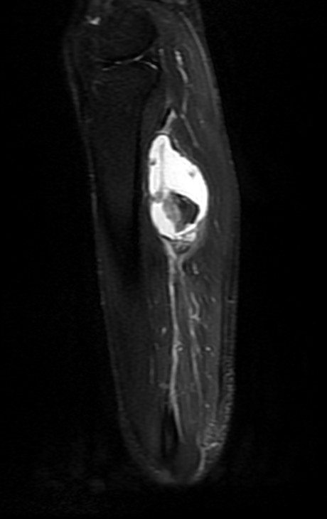 Sagittal STIR, left leg