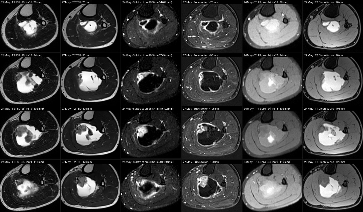 MRI 24 May vs MRI 27 May at matched levels below the knee joint line