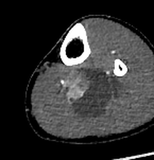 CT angiography, arterial phase, 11.0 cm below joint