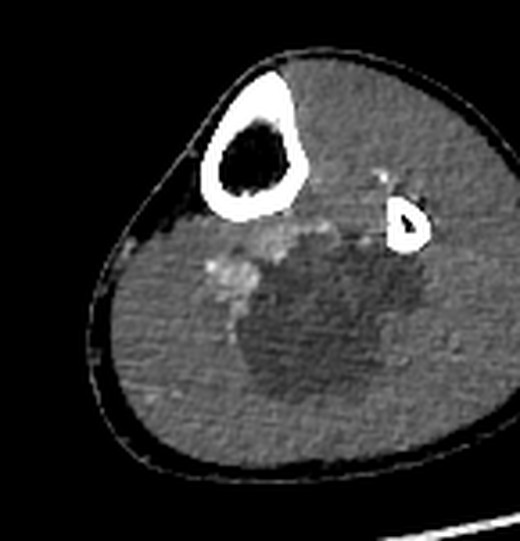CT angiography, arterial phase, 9.6 cm below joint
