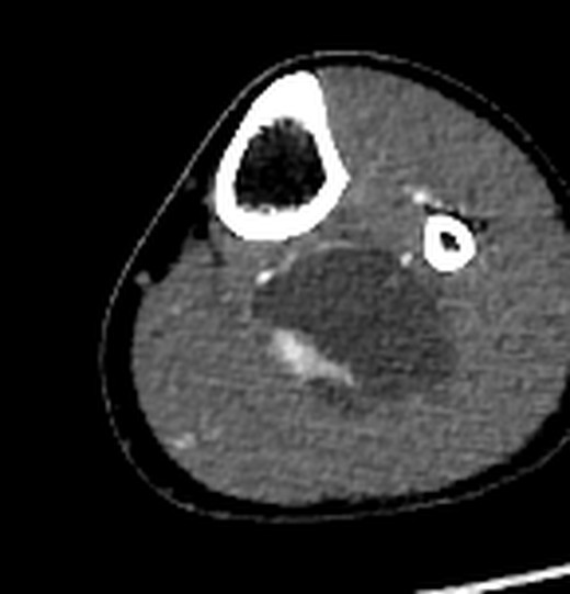 CT angiography, arterial phase, 7.8 cm below joint