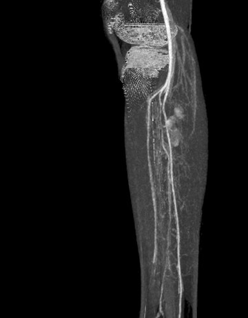 Arterial MIP (bone removed), lateral view
