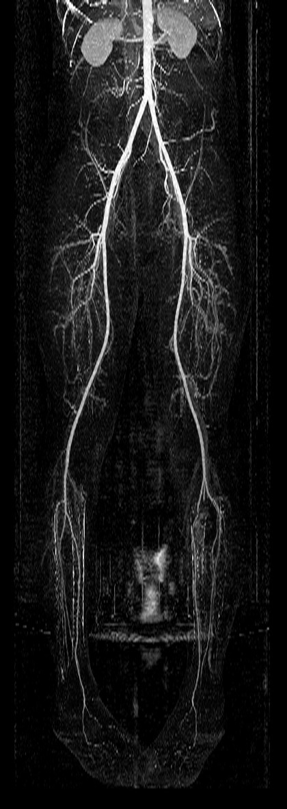 Subtraction angiography MIP, aorta to feet