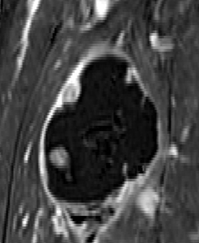 Coronal subtraction: transverse and craniocaudal