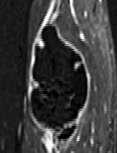 Sagittal subtraction: craniocaudal and AP diameters