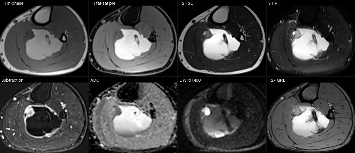 Multiparametric MRI at 9.5 cm below joint