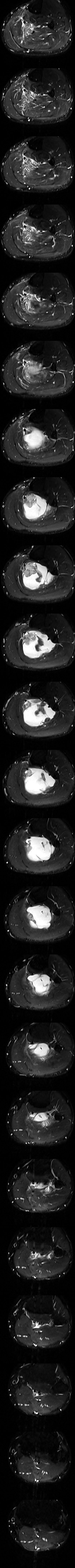 Delhi MRI · axial STIR
