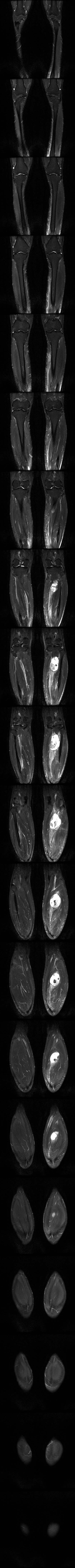Kathmandu MRI · coronal STIR, both legs