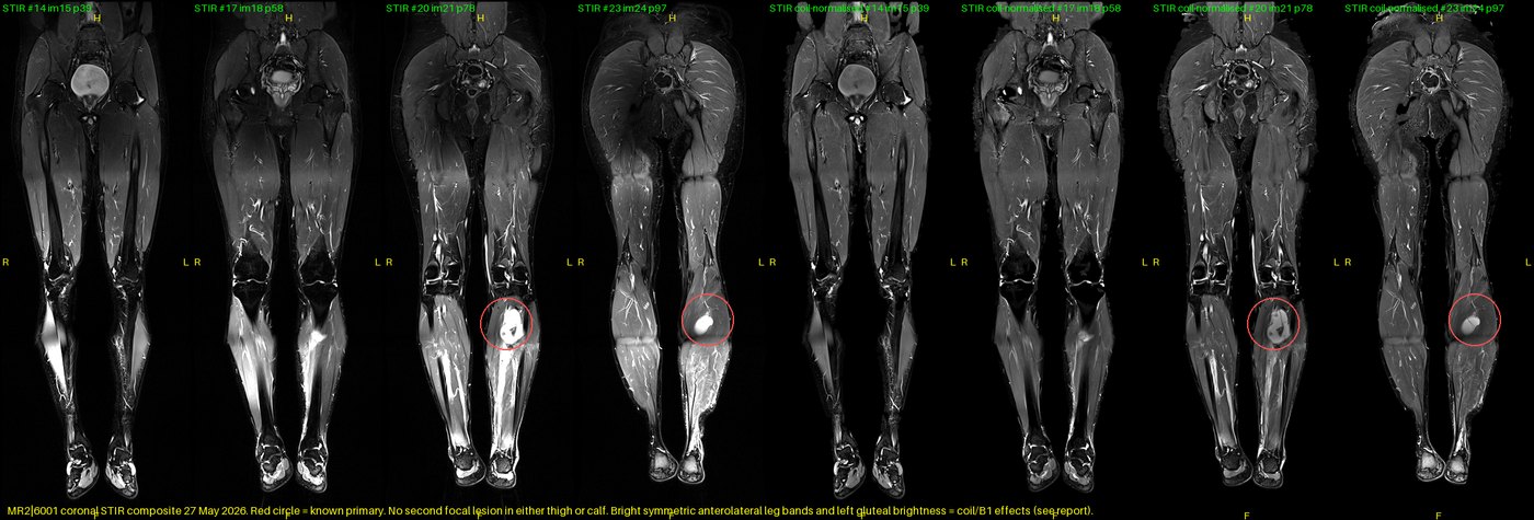 Coronal STIR, both lower limbs: second-lesion survey