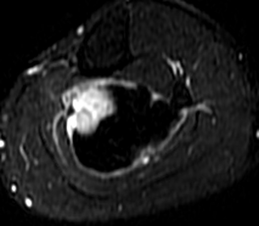 MRI 24 May, Subtraction, 10.5 cm below joint