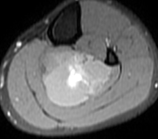 MRI 24 May, T1 fat-suppressed pre-contrast, 9 cm below joint