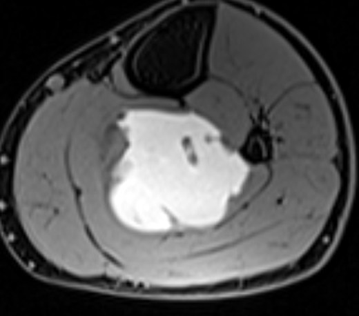 MRI 27 May, T1 fat-suppressed pre-contrast, 9 cm below joint