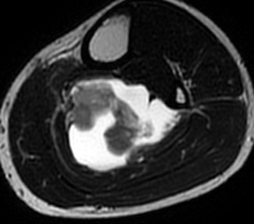MRI 24 May, T2, 10.5 cm below joint