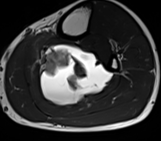 MRI 27 May, T2, 10.5 cm below joint