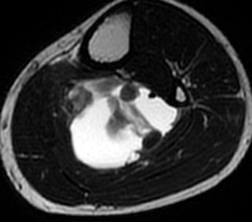 MRI 24 May, T2, 9 cm below joint