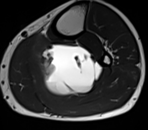 MRI 27 May, T2, 9 cm below joint